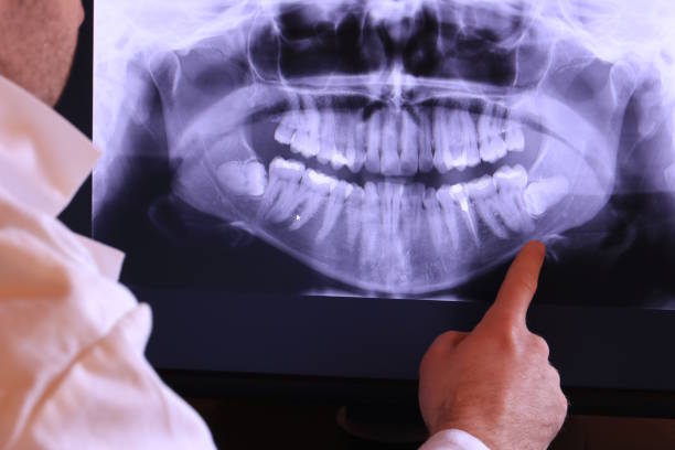 Best Knocked-Out Tooth (Avulsed Tooth) Treatment in Carthage, NY